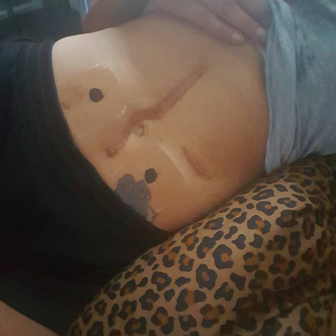Brittney J abdomen during recovery after ostomy surgery